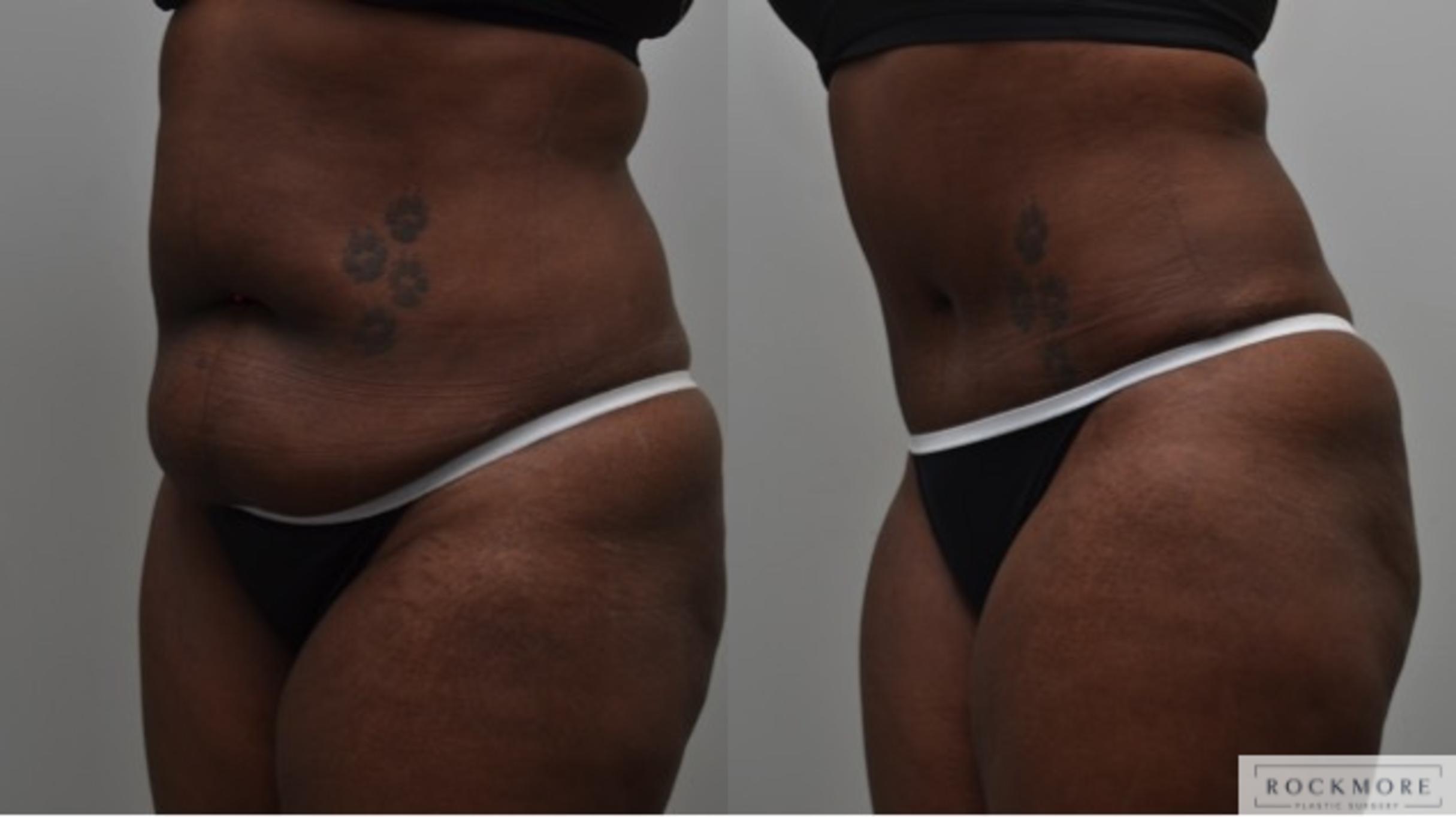 Before & After Liposuction Case 281 View #5 View in Albany & Latham, New York