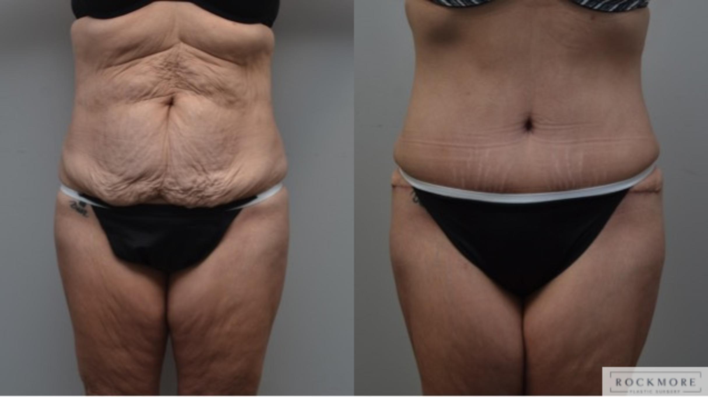 Before & After Liposuction Case 288 View #1 View in Albany & Latham, New York