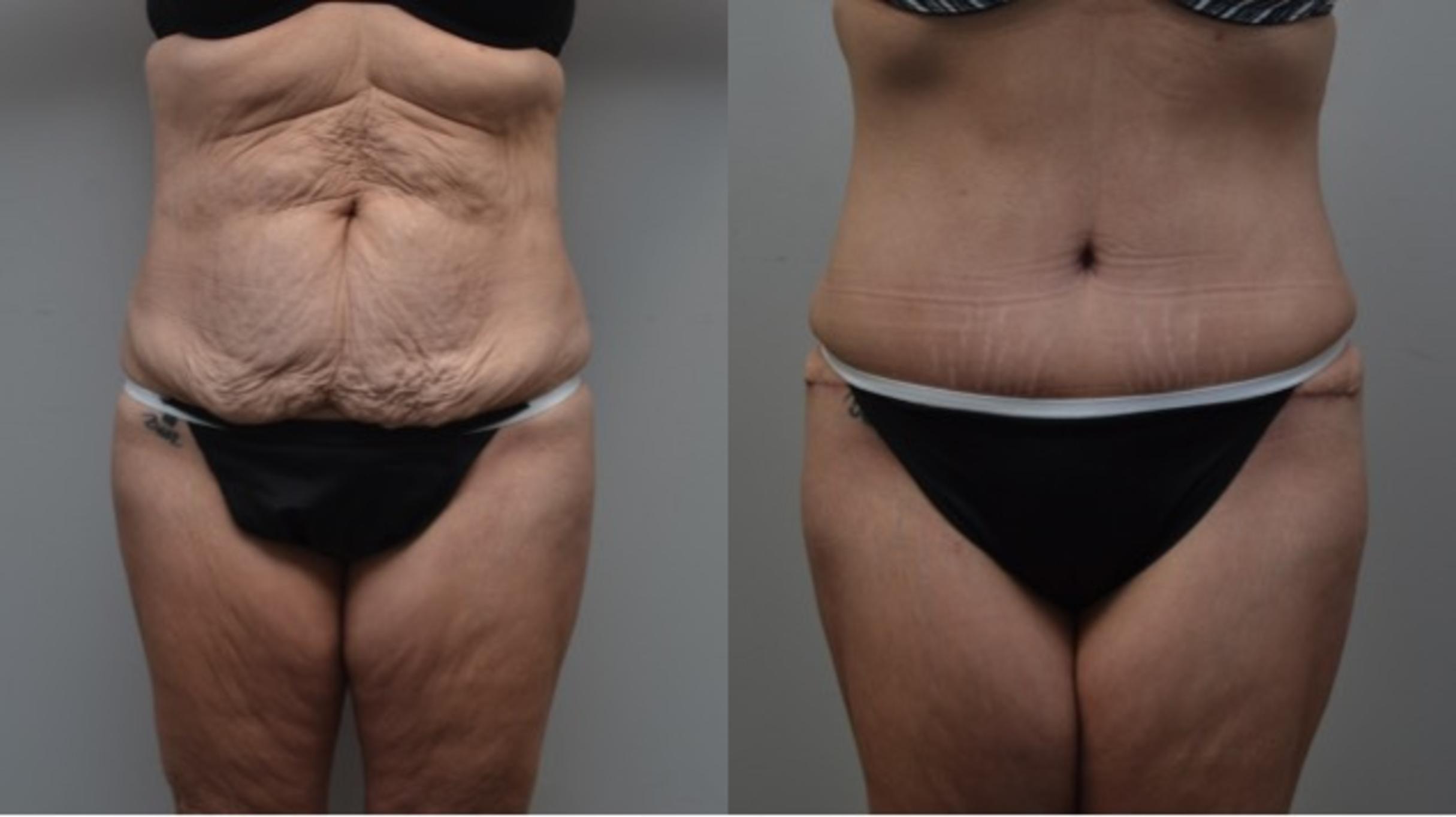 Before & After Liposuction Case 288 View #1 View in Albany & Latham, New York