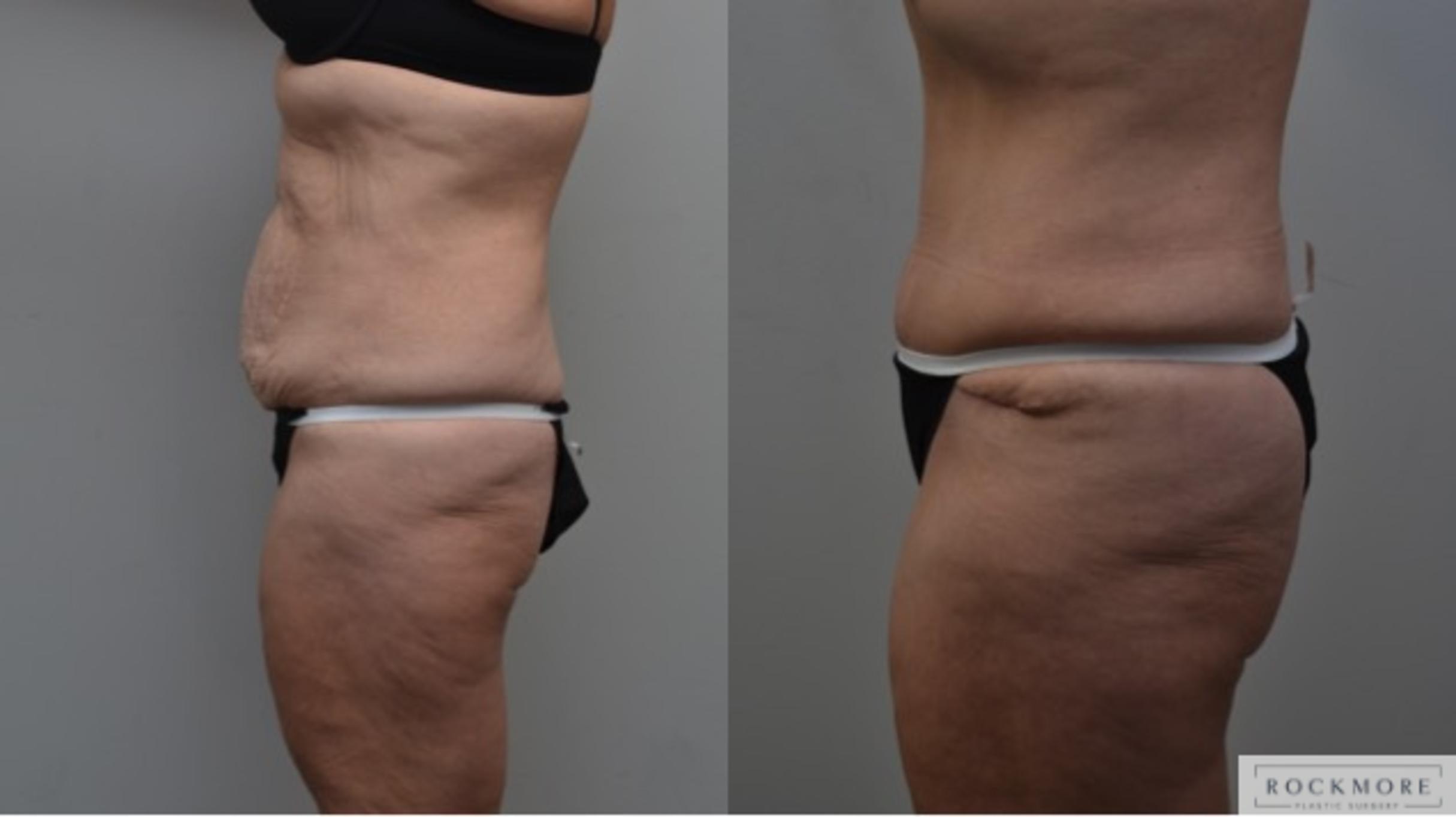 Before & After Liposuction Case 288 View #2 View in Albany & Latham, New York