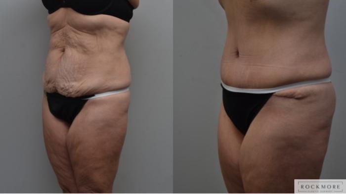 Before & After Tummy Tuck Case 288 View #3 View in Albany & Latham, New York