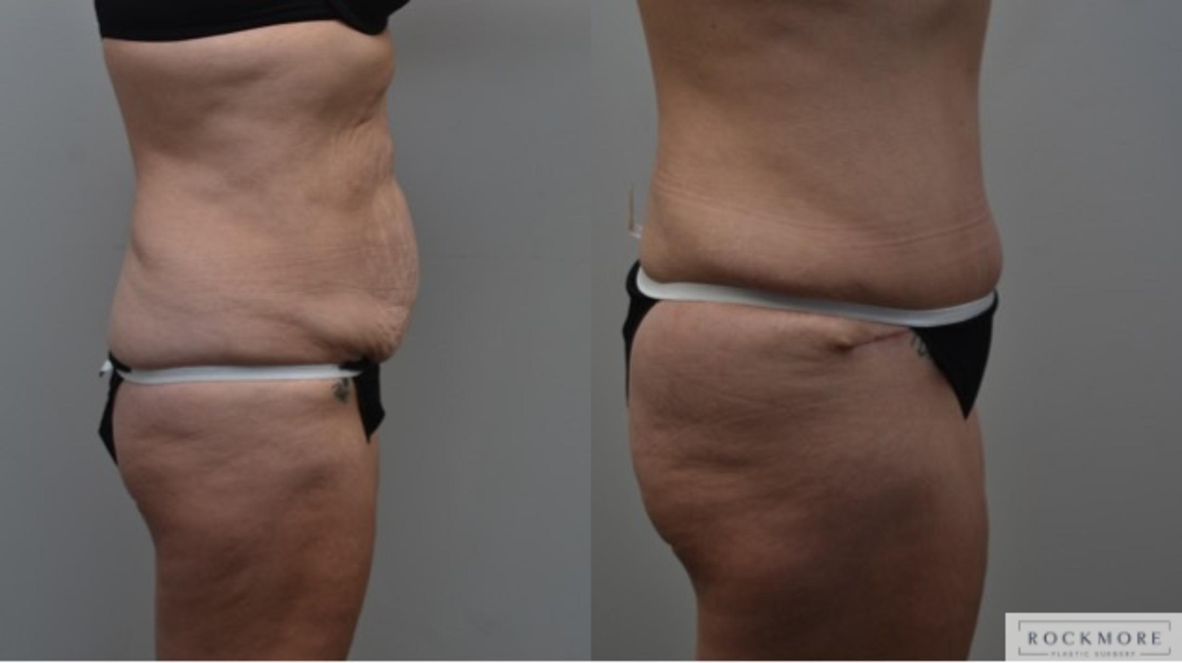 Before & After Liposuction Case 288 View #4 View in Albany & Latham, New York