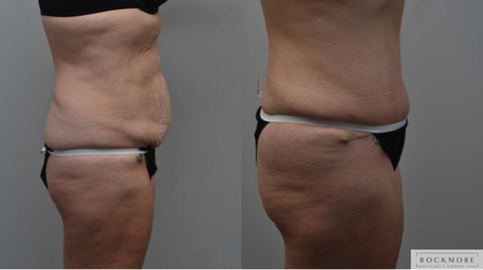 Before & After Tummy Tuck Case 288 View #4 View in Albany & Latham, New York