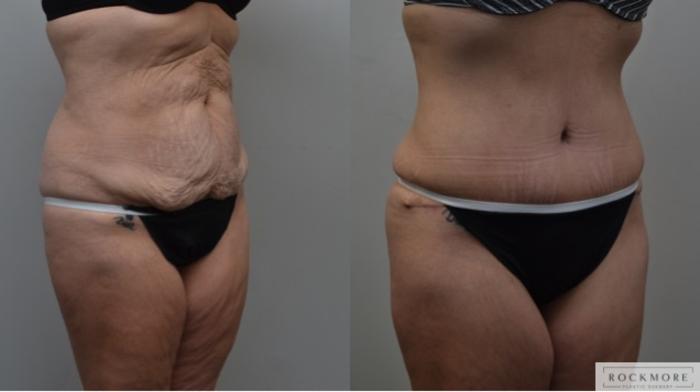 Before & After Tummy Tuck Case 288 View #5 View in Albany & Latham, New York