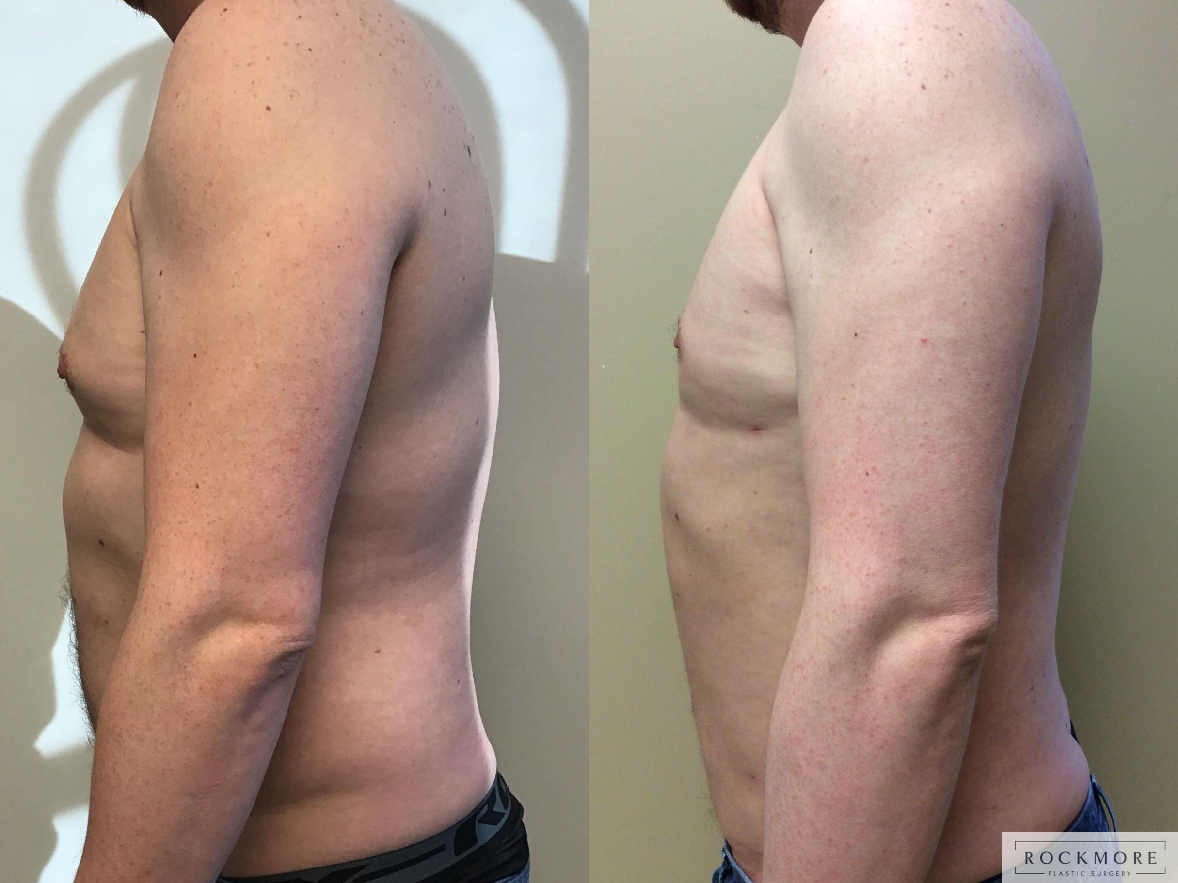 Before & After Liposuction Case 310 Left Side View in Albany & Latham, New York