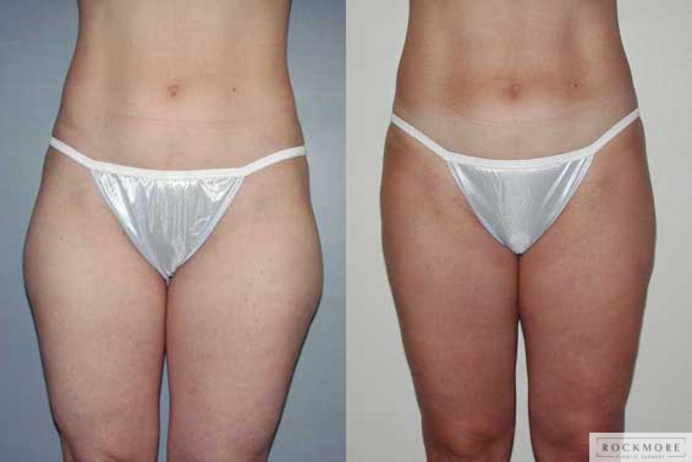 Before & After Liposuction Case 4 View #1 View in Albany & Latham, New York