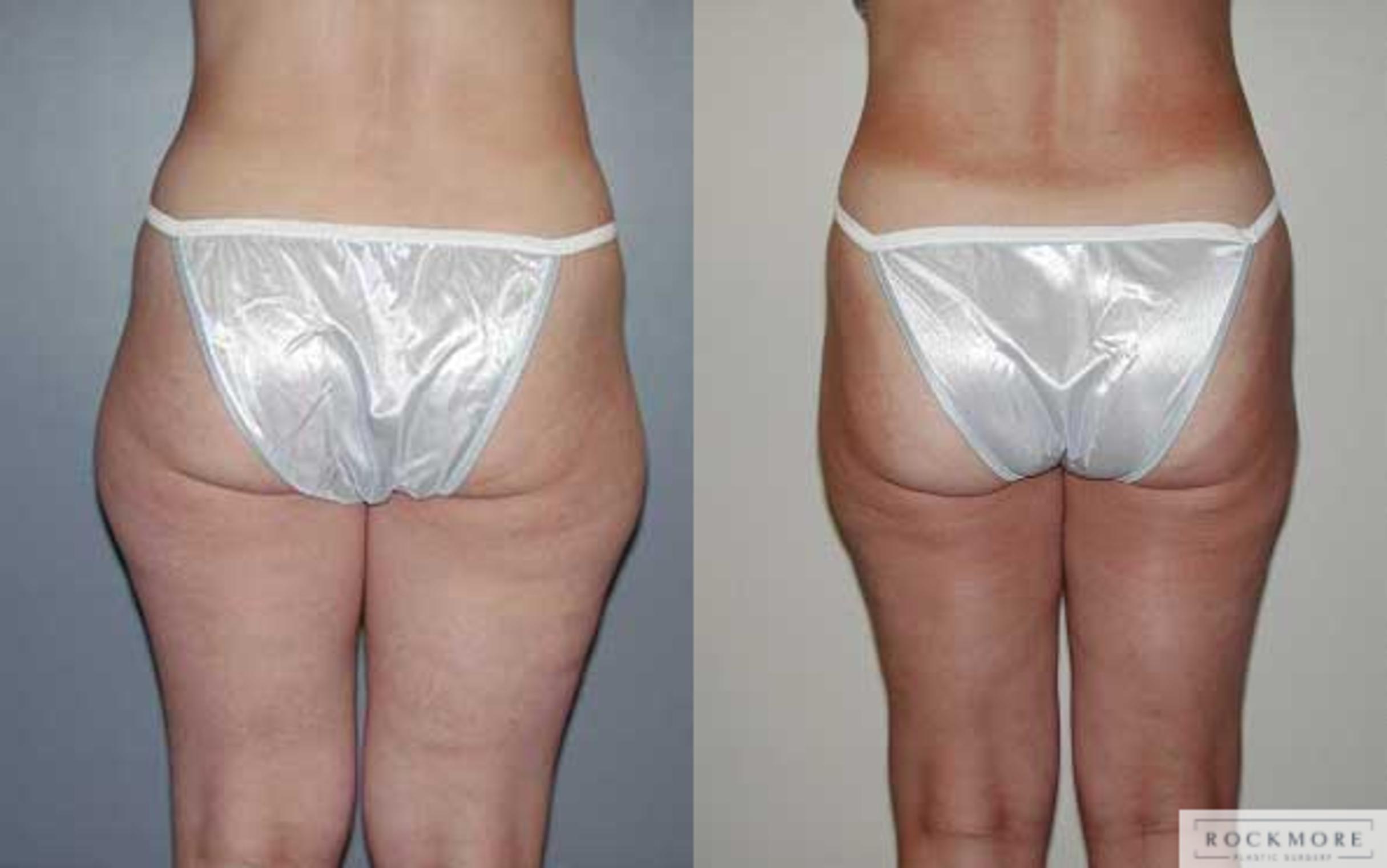Before & After Liposuction Case 4 View #2 View in Albany & Latham, New York
