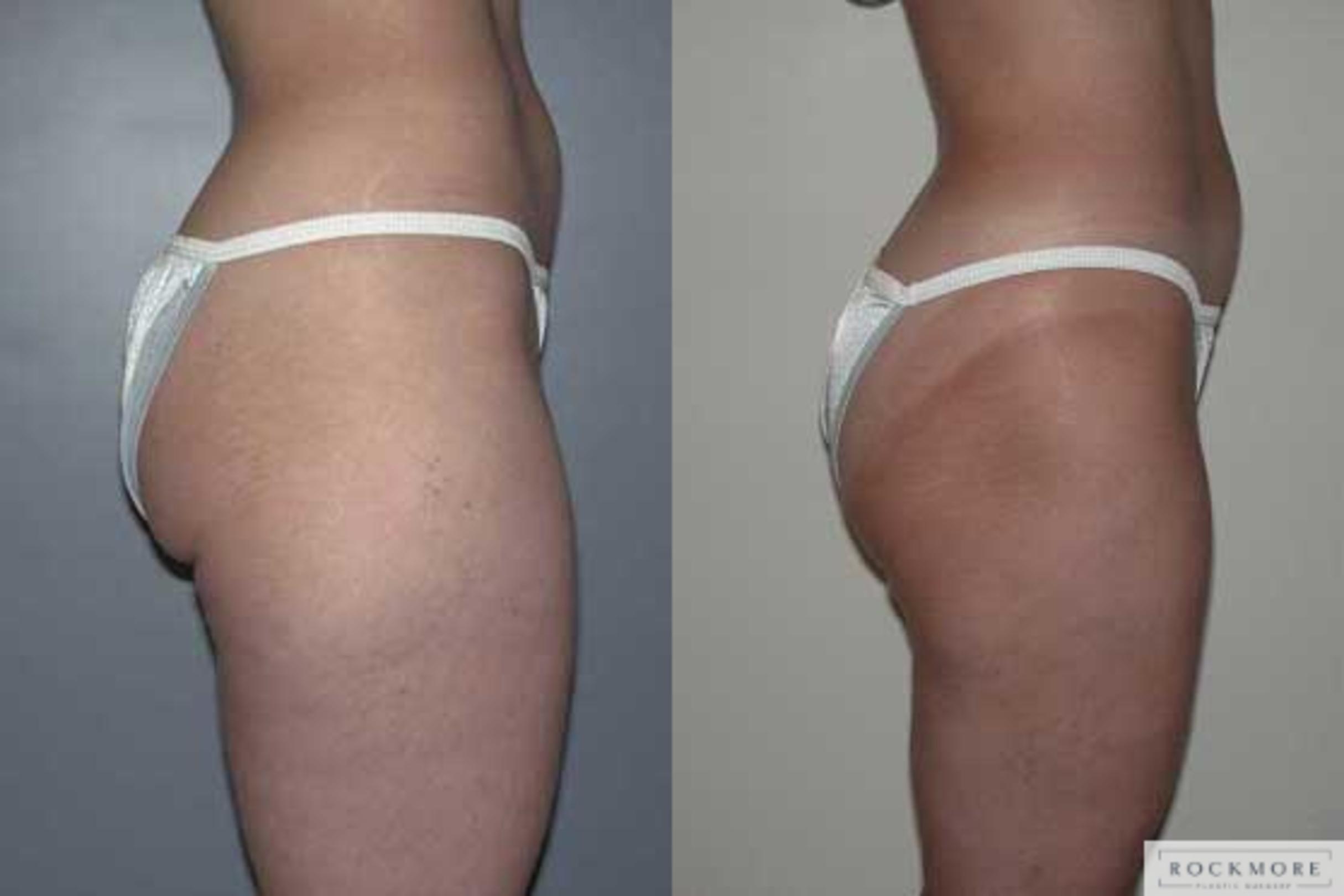 Before & After Liposuction Case 4 View #3 View in Albany & Latham, New York