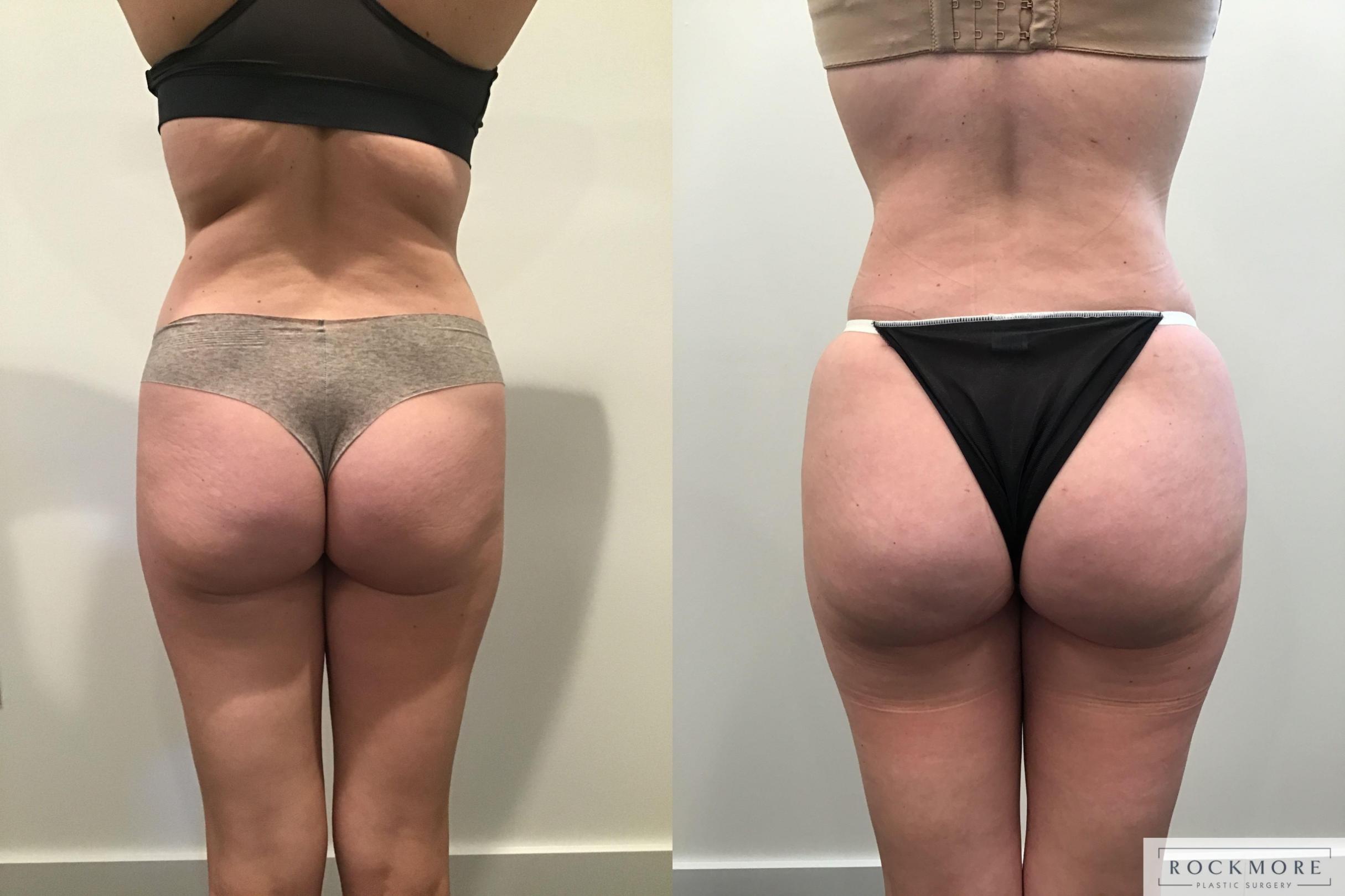 Before & After Brazilian Butt Lift Case 405 Back 2 View in Albany & Latham, New York