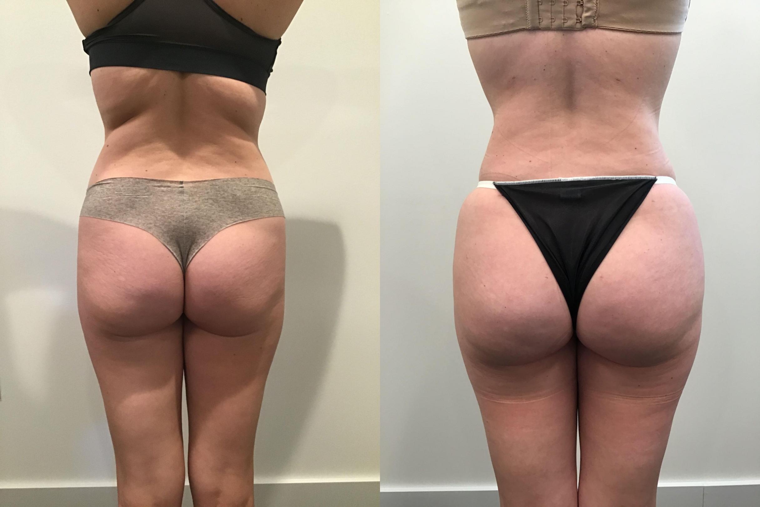 Lipo For Women Before & After NYC