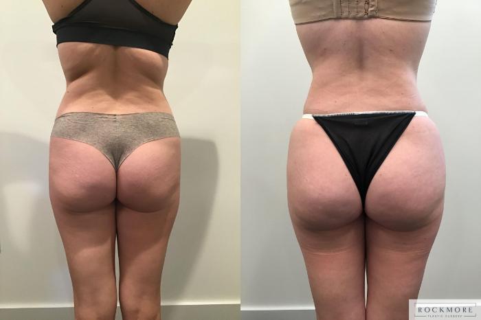 Before & After Liposuction Case 405 Back 2 View in Albany & Latham, New York