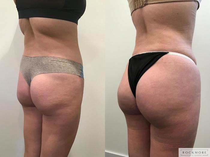 Before & After Liposuction Case 405 Back View in Albany & Latham, New York