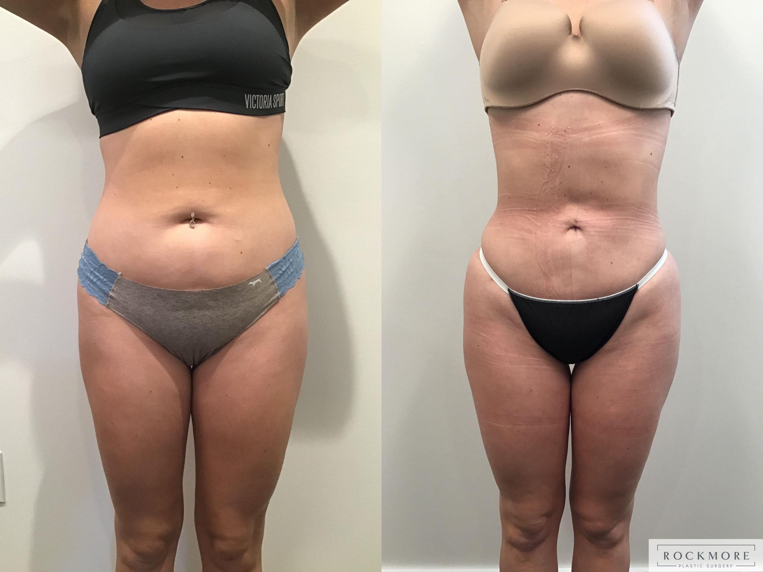 Before & After Liposuction Case 405 Front View in Albany & Latham, New York