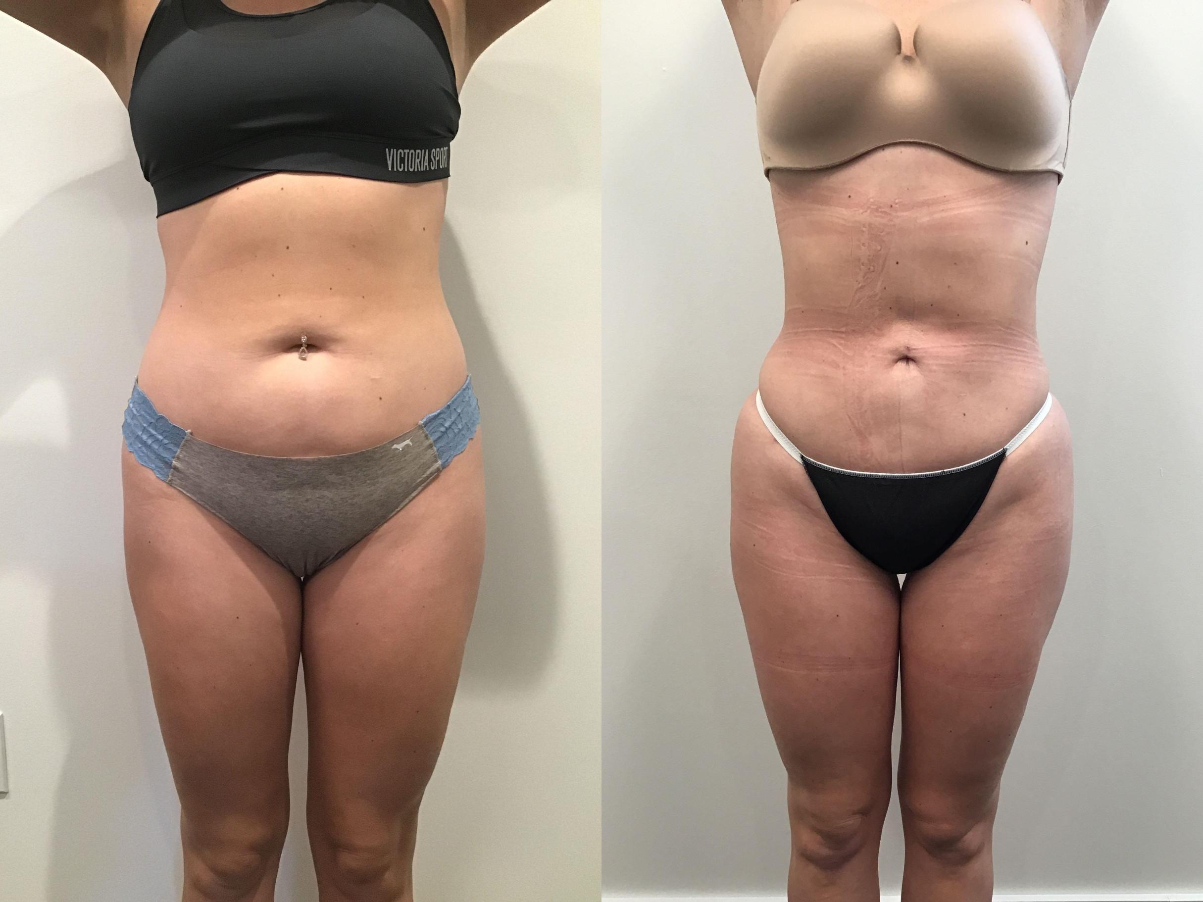 360 lipo Before and after