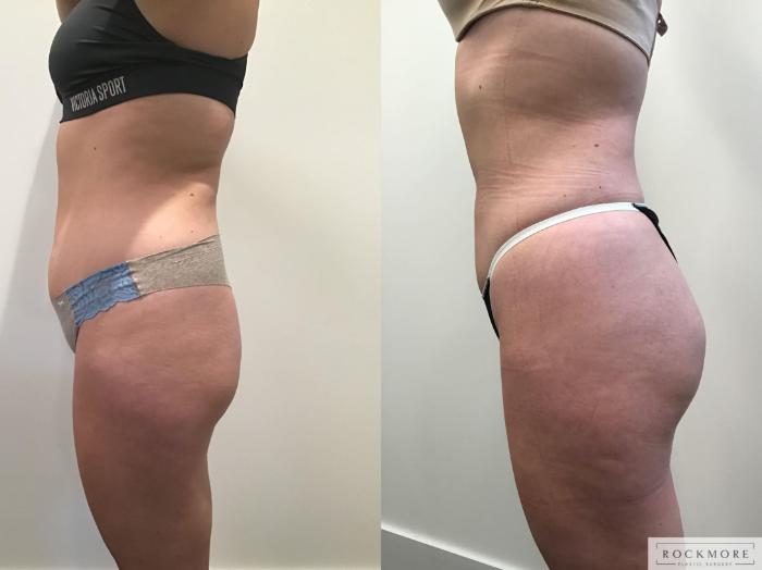 Before & After Liposuction Case 405 Left Side View in Albany & Latham, New York