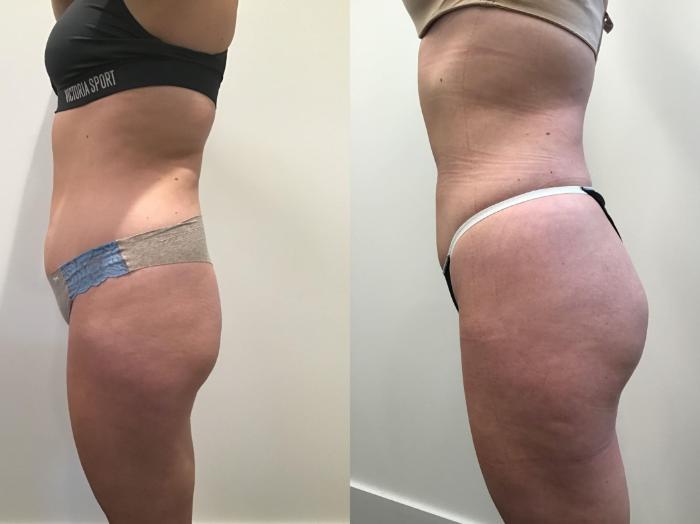 Liposuction Before and After Pictures Case 405