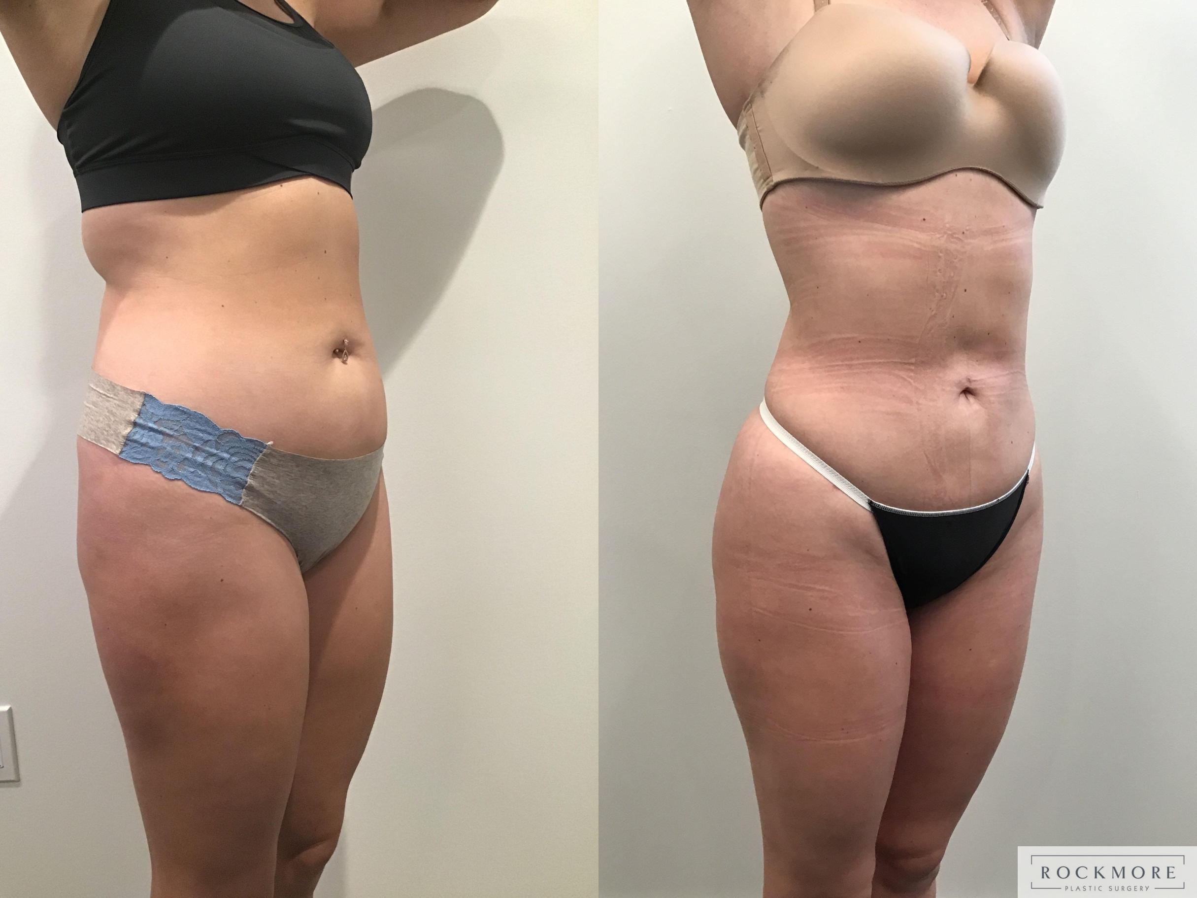 Before & After Liposuction Case 405 Right Oblique View in Albany & Latham, New York
