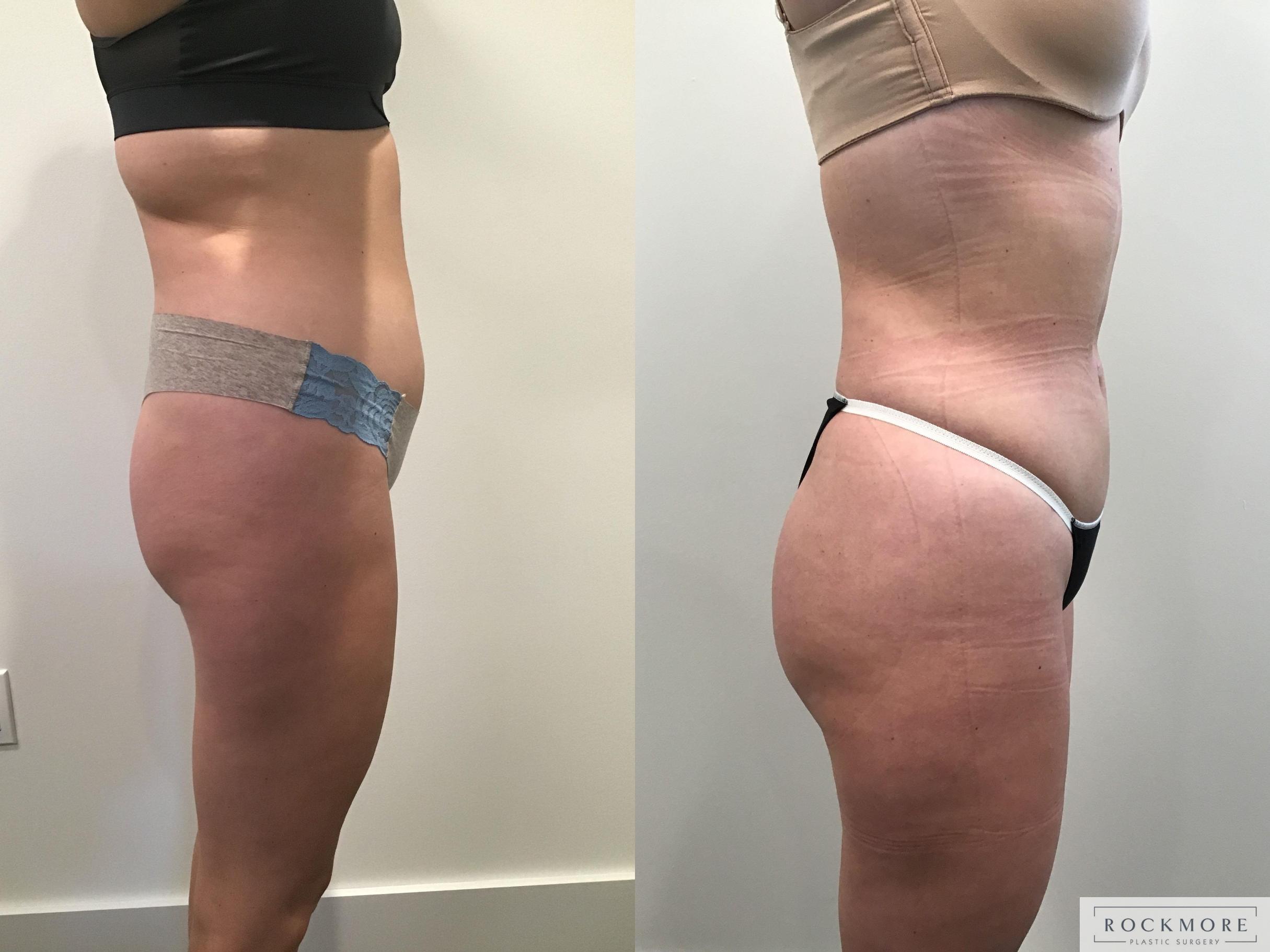 Before & After Liposuction Case 405 Right Side View in Albany & Latham, New York