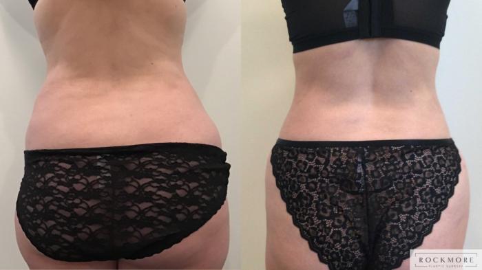 Before & After Liposuction Case 420 Back View in Albany & Latham, New York