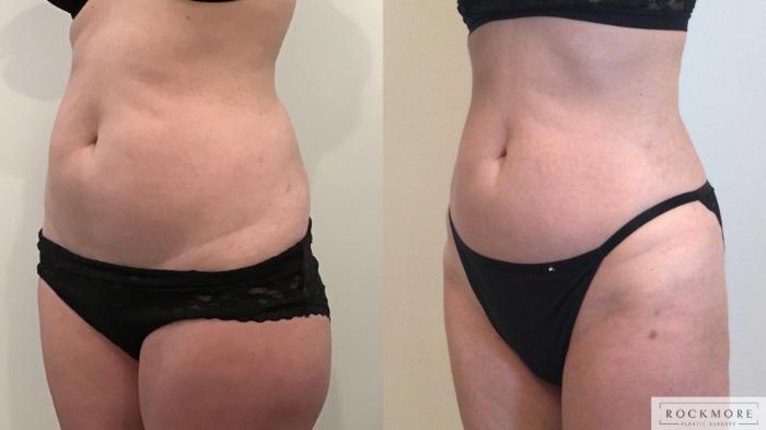 Before & After Liposuction Case 420 Left Oblique View in Albany & Latham, New York