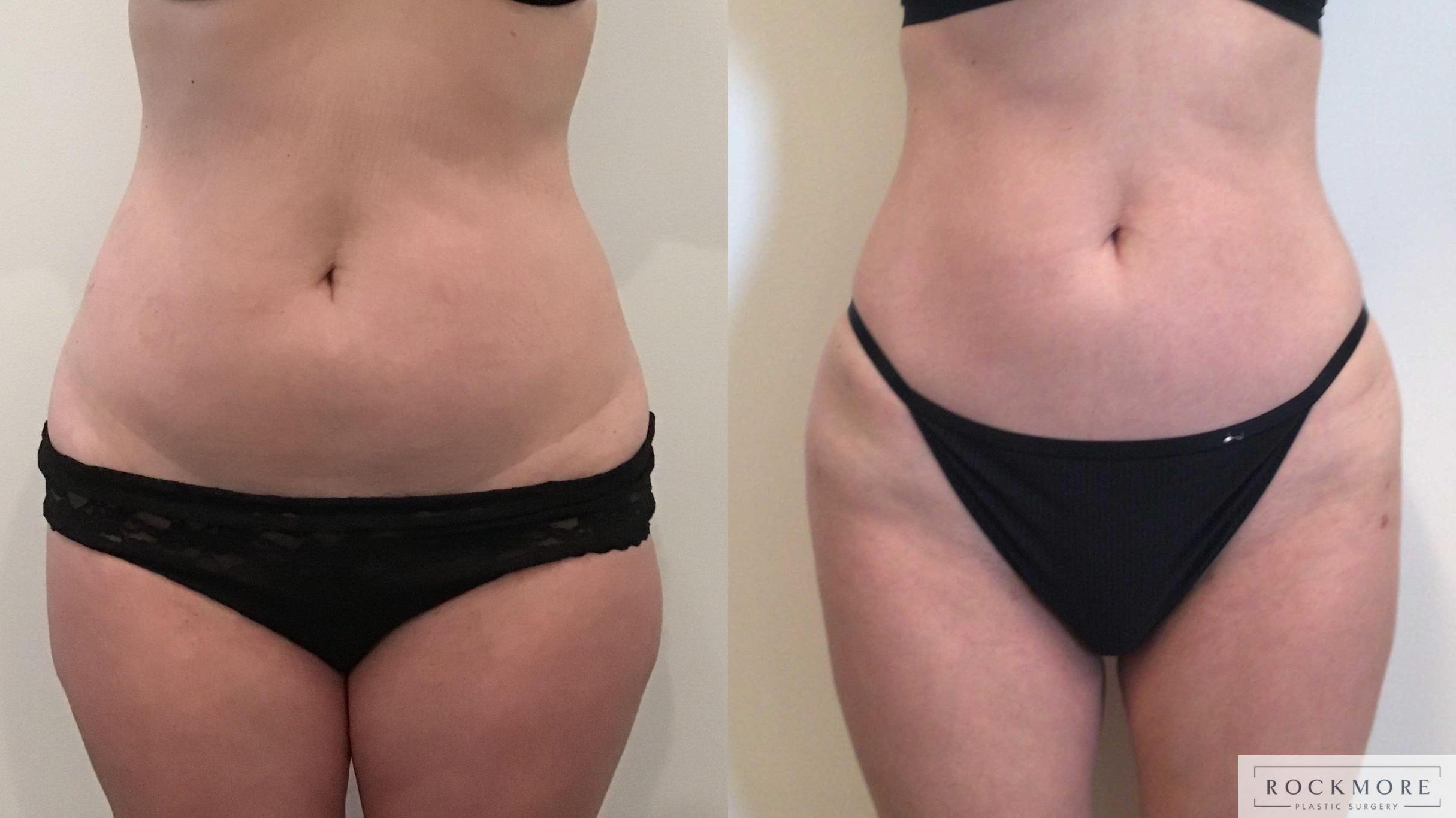 Before & After Liposuction Case 420 Left Side View in Albany & Latham, New York