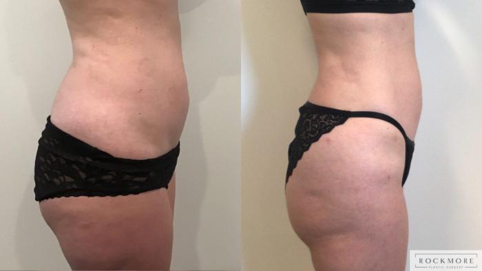 Before & After Liposuction Case 420 Right Side View in Albany & Latham, New York