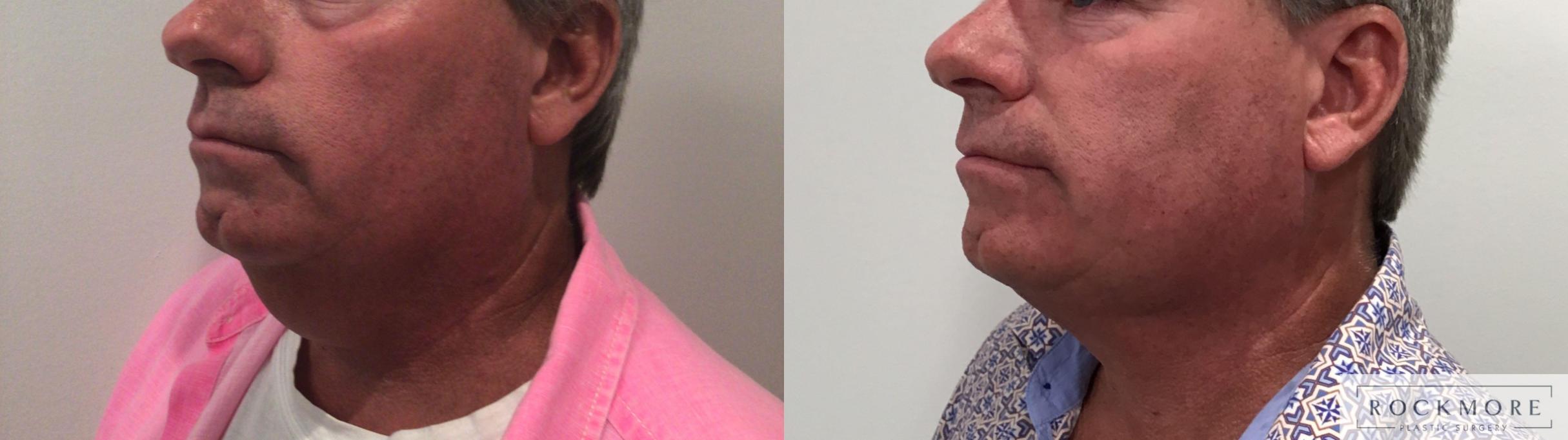 Before & After Featured Cases Case 426 Left Oblique View in Albany & Latham, New York