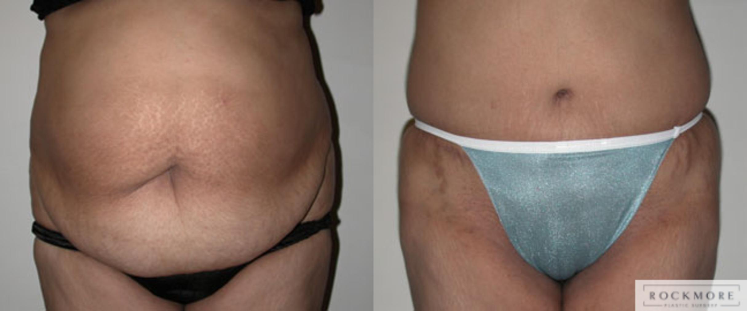 Before & After Liposuction Case 43 View #1 View in Albany & Latham, New York