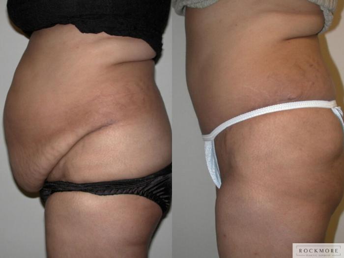 Before & After Liposuction Case 43 View #2 View in Albany & Latham, New York