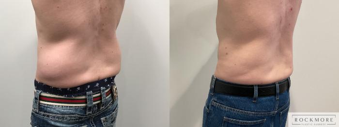 Before & After Liposuction Case 457 Left Oblique View in Albany & Latham, New York