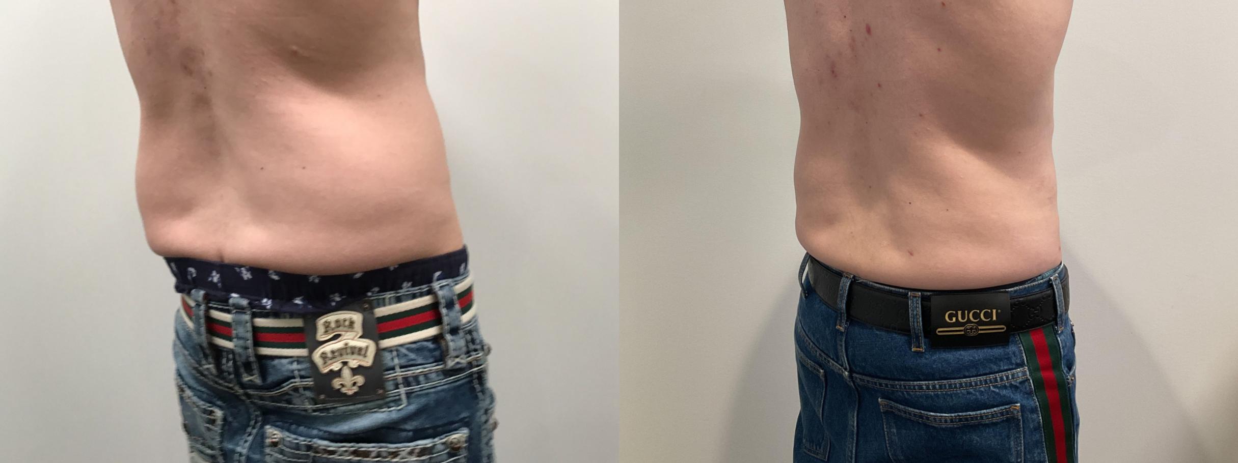 Liposuction Before and After Pictures Case 457 Albany & Latham, New