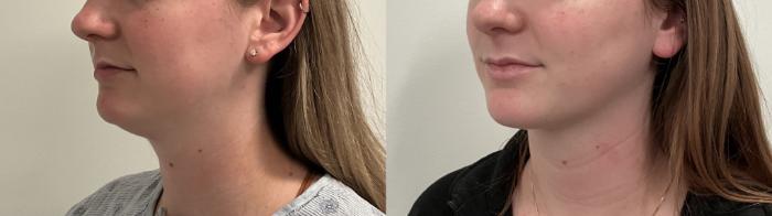 Before & After Liposuction Case 497 Left Oblique View in Albany, Latham & Saratoga, New York