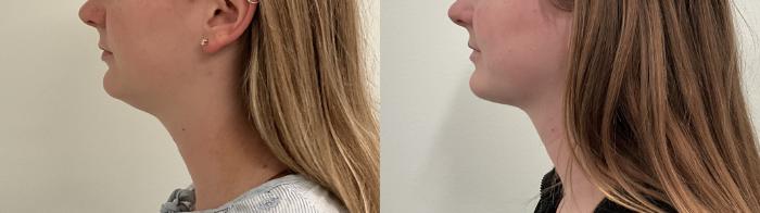 Before & After Liposuction Case 497 Left Side View in Albany, Latham & Saratoga, New York