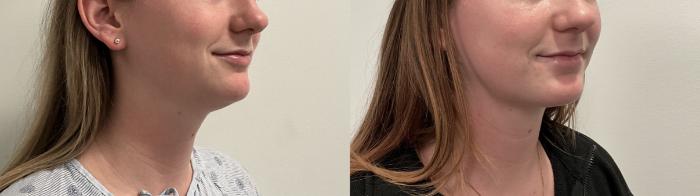 Before & After Liposuction Case 497 Right Oblique View in Albany, Latham & Saratoga, New York