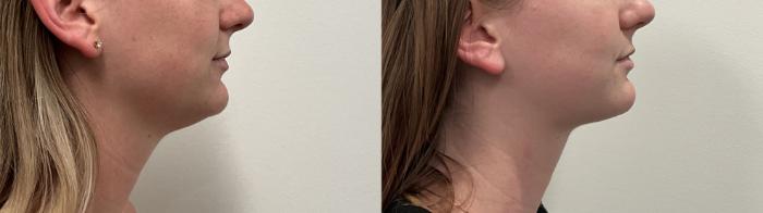 Before & After Liposuction Case 497 Right Side View in Albany, Latham & Saratoga, New York