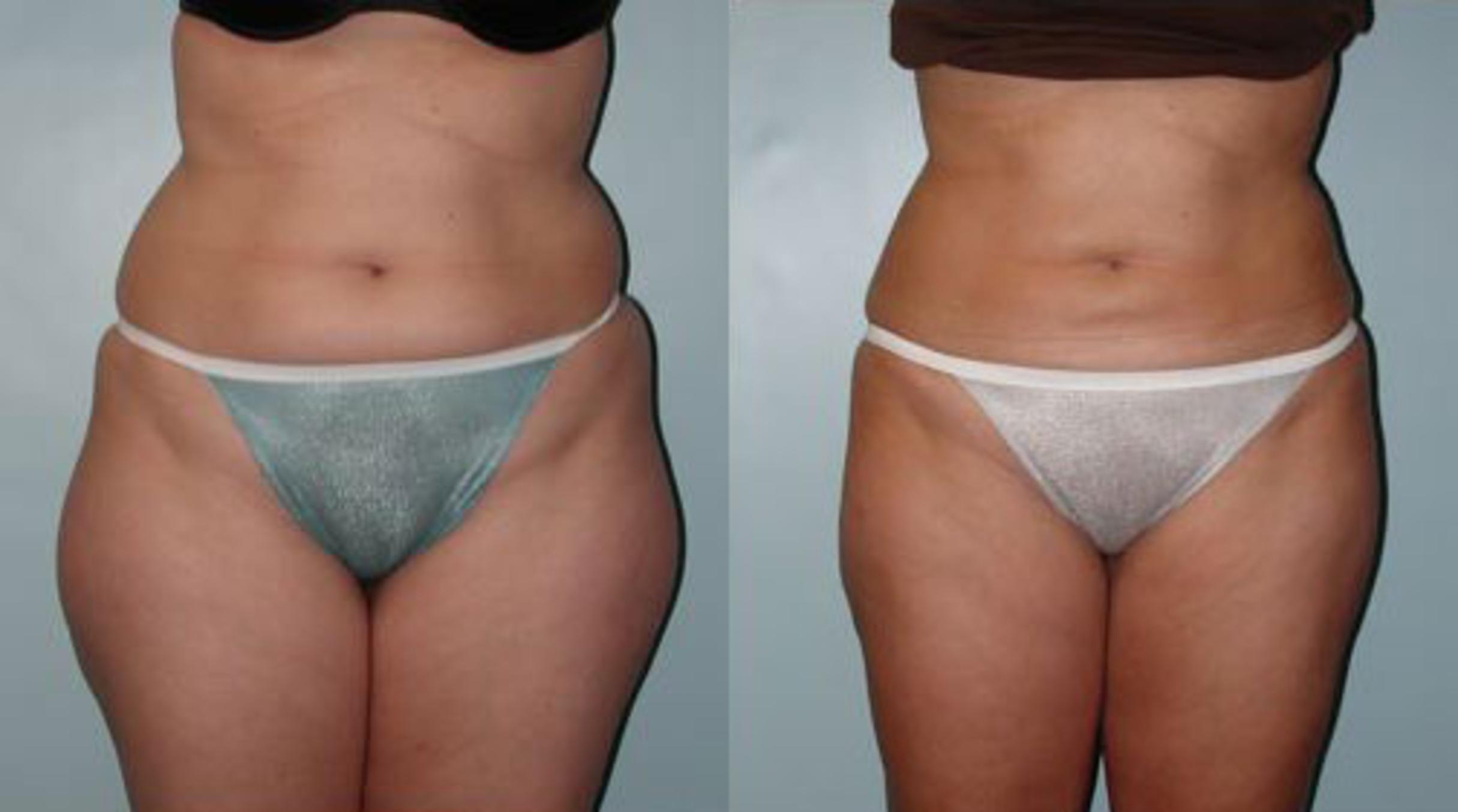 Liposuction Before and After Photo Gallery, Albany & Latham, New York