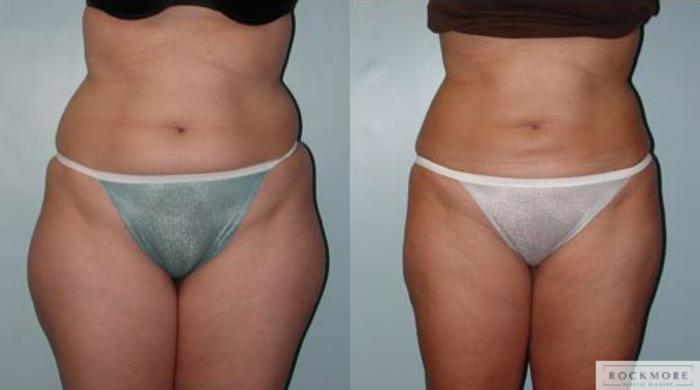 Before & After Liposuction Case 66 View #1 View in Albany & Latham, New York