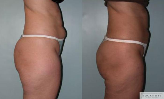 Before & After Liposuction Case 66 View #2 View in Albany & Latham, New York