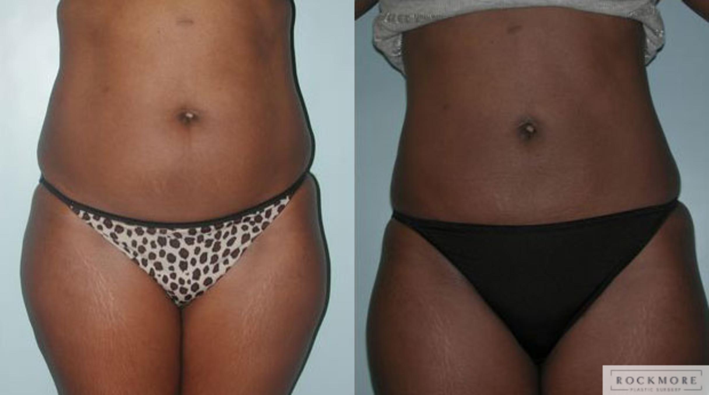 Before & After Liposuction Case 84 View #1 View in Albany & Latham, New York