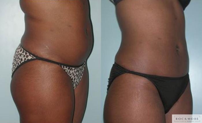 Before & After Liposuction Case 84 View #2 View in Albany & Latham, New York