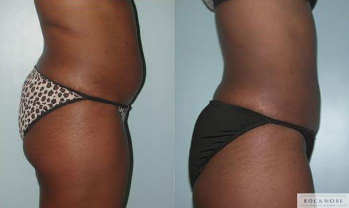 Before & After Liposuction Case 84 View #3 View in Albany & Latham, New York