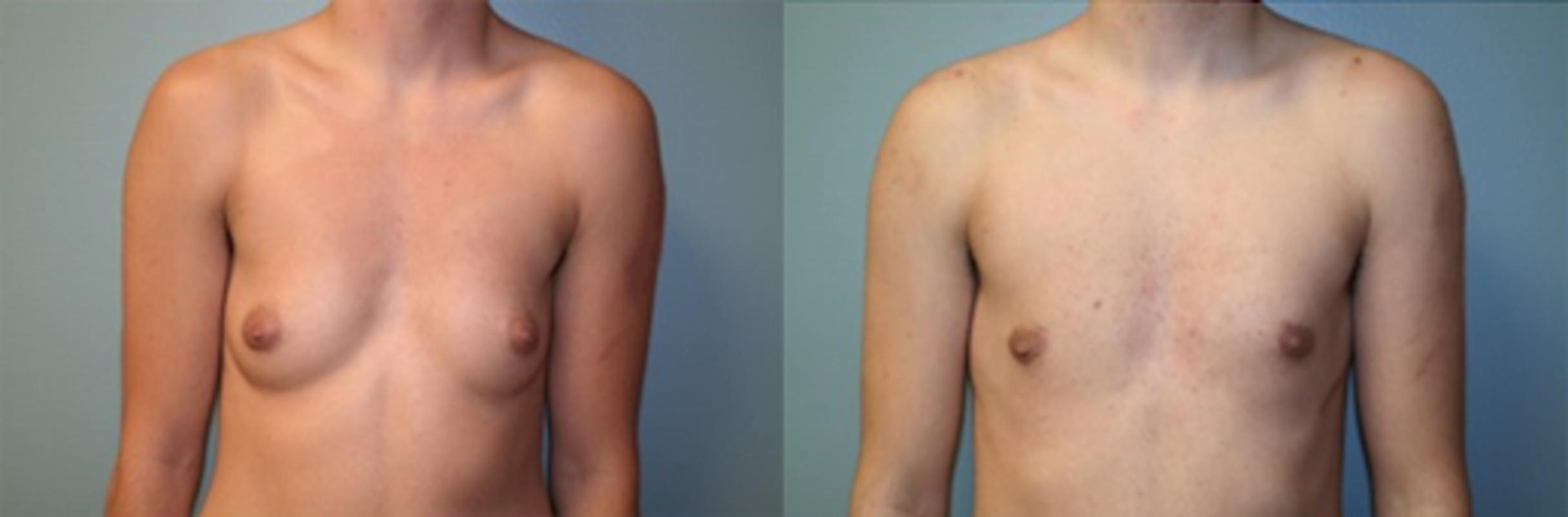 Before & After Male Breast Reduction (Gynecomastia) Case 124 View #1 View in Albany & Latham, New York