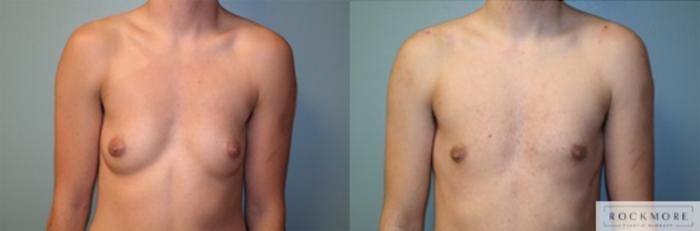 Before & After Male Breast Reduction (Gynecomastia) Case 124 View #1 View in Albany & Latham, New York