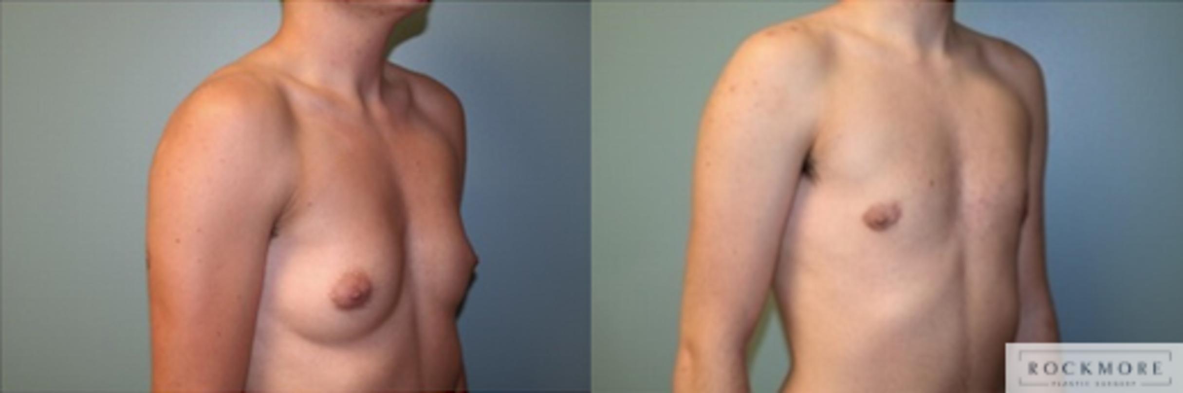 Before & After Male Breast Reduction (Gynecomastia) Case 124 View #2 View in Albany & Latham, New York