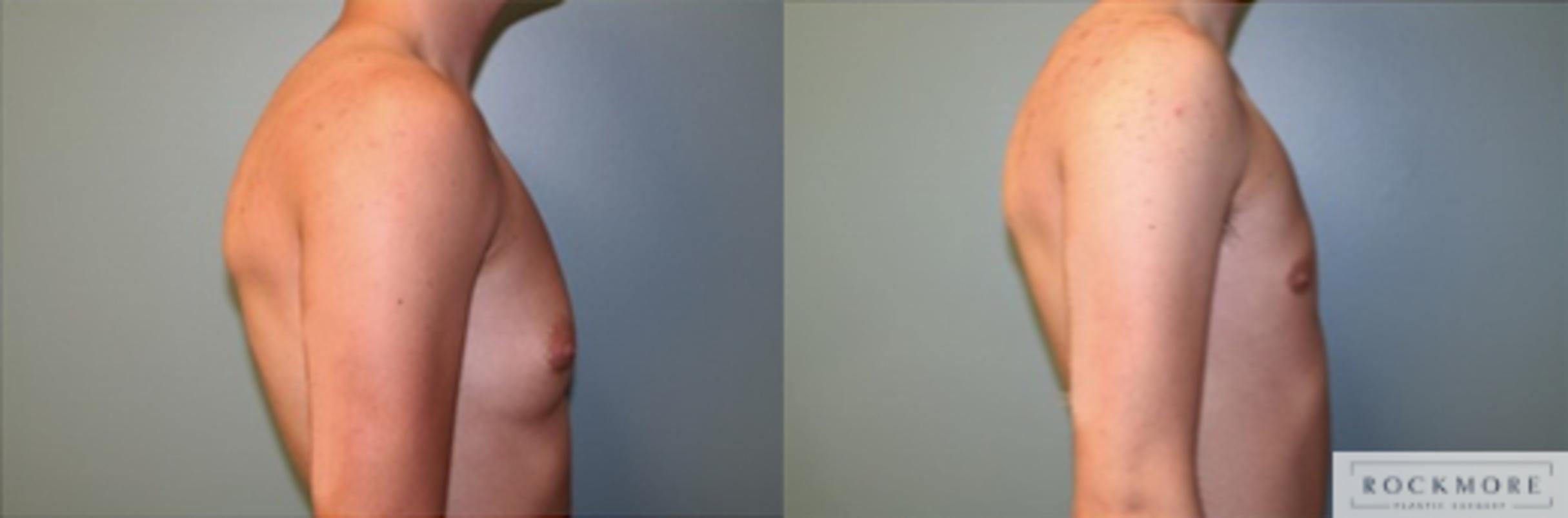 Before & After Male Breast Reduction (Gynecomastia) Case 124 View #3 View in Albany & Latham, New York