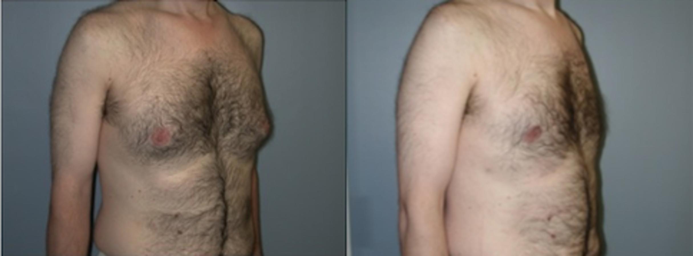 Before & After Male Breast Reduction (Gynecomastia) Case 126 View #1 View in Albany & Latham, New York