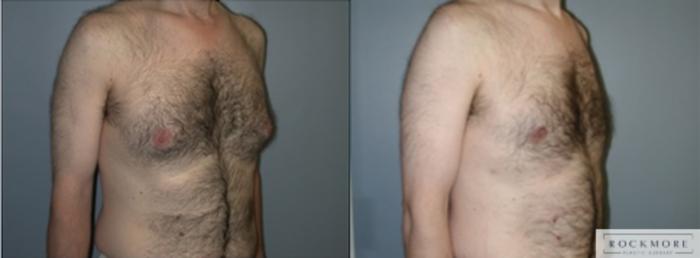 Before & After Male Breast Reduction (Gynecomastia) Case 126 View #1 View in Albany & Latham, New York