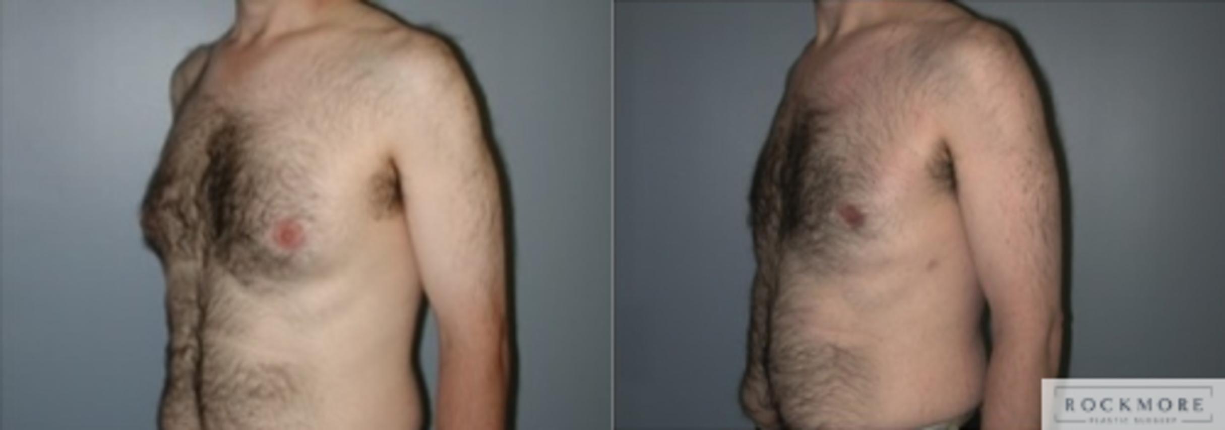 Before & After Male Breast Reduction (Gynecomastia) Case 126 View #2 View in Albany & Latham, New York
