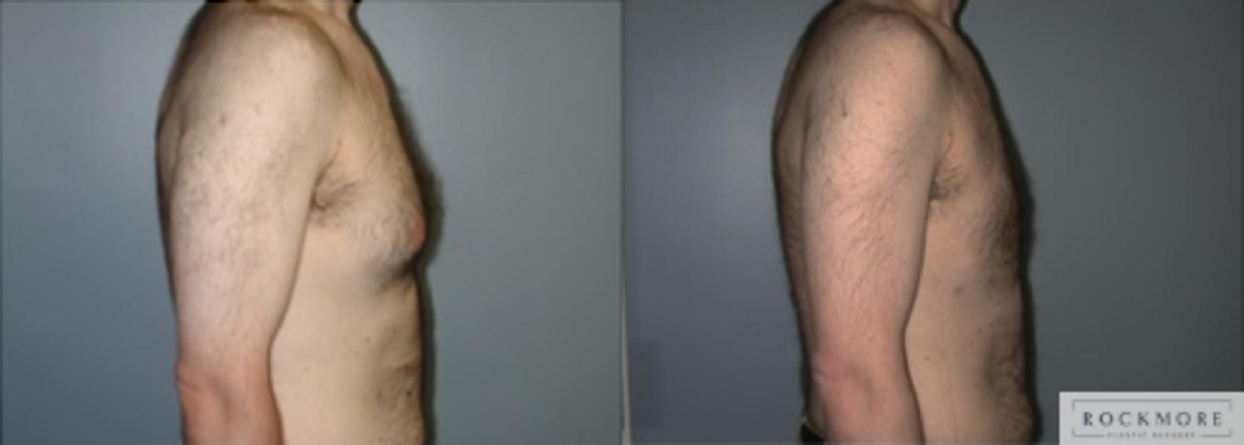 Before & After Male Breast Reduction (Gynecomastia) Case 126 View #3 View in Albany & Latham, New York