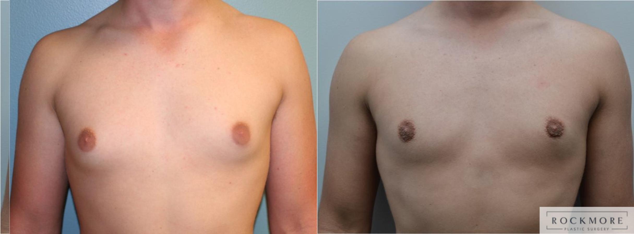 Before & After Male Breast Reduction (Gynecomastia) Case 187 View #1 View in Albany & Latham, New York